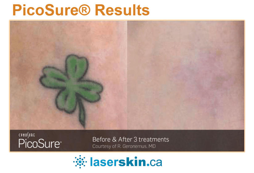 Pico-tattoo-removal-before-and-after-3