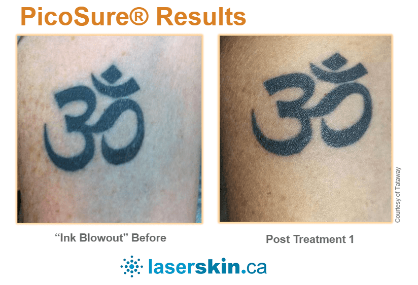 Laser Tattoo Removal Before And After – All you need to learn about tattoo  removal. Article teaser - YouTube