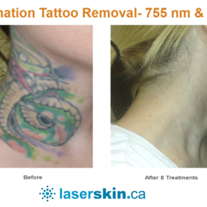 Pico-tattoo-removal-before-and-after-7