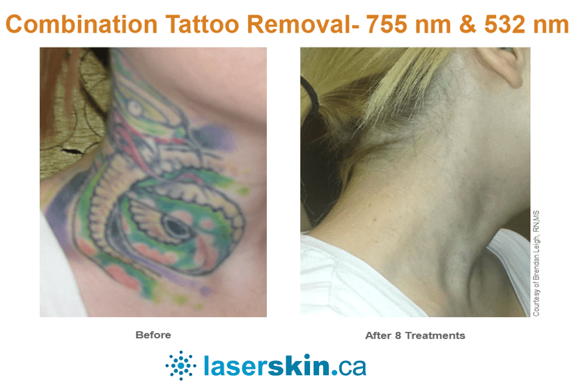 Pico-tattoo-removal-before-and-after-7