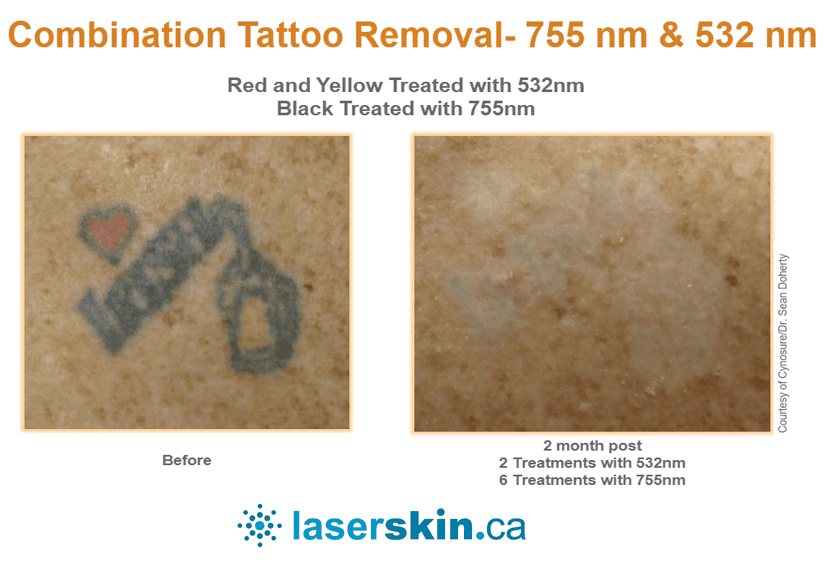 Pico-tattoo-removal-before-and-after-8