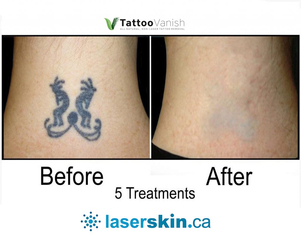 Before and After Tattoo Removal  Get the Best Results the AllNatural Way   Tattoo Removal Pictures  Photos  Tattoo Vanish