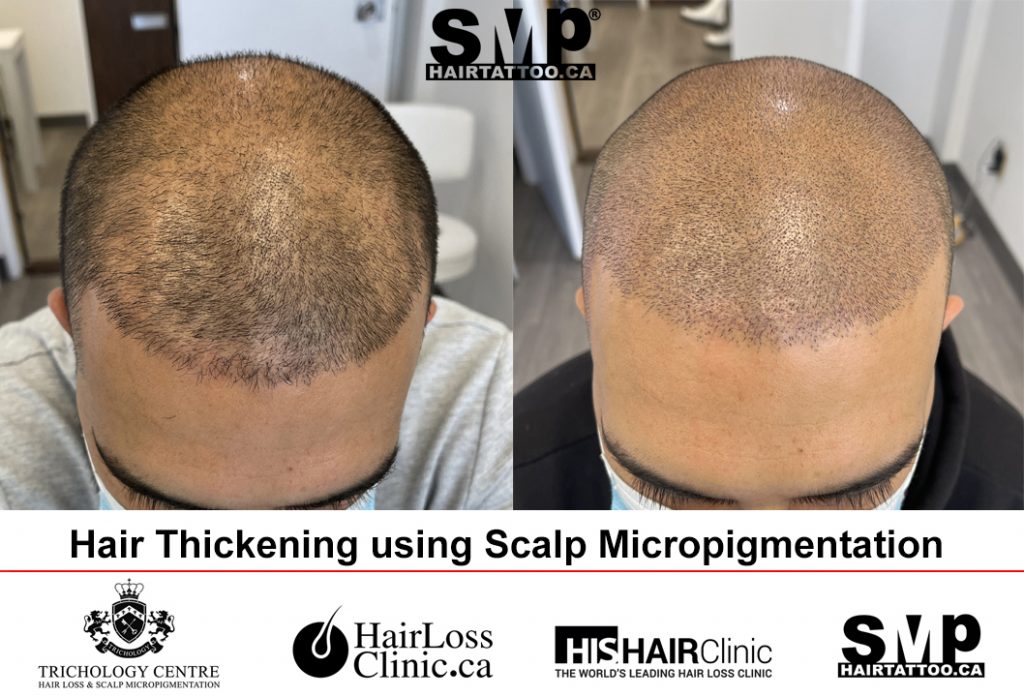 Scalp micropigmentation before and after 3
