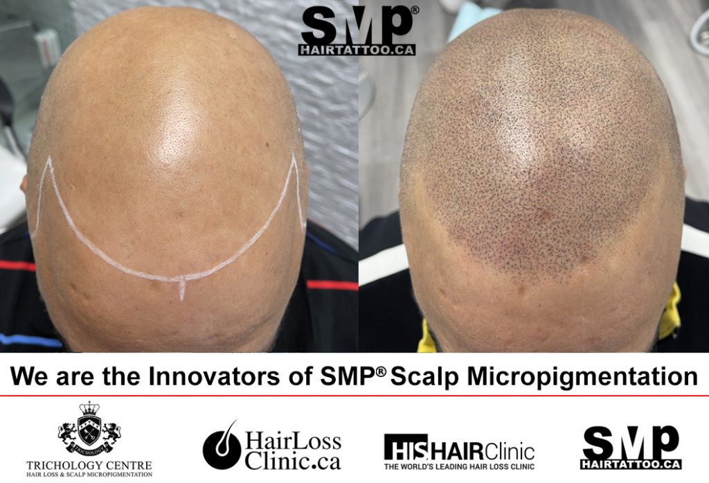 Scalp Micro Pigmentation Before and After 5