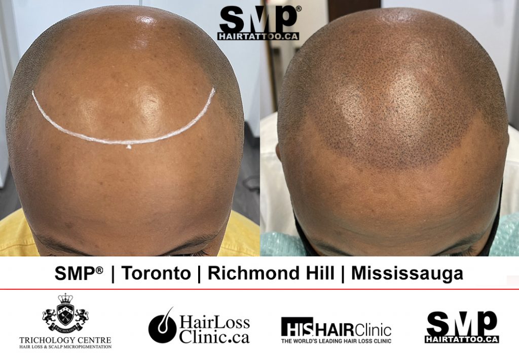 scalp micropigmentation before and after 7