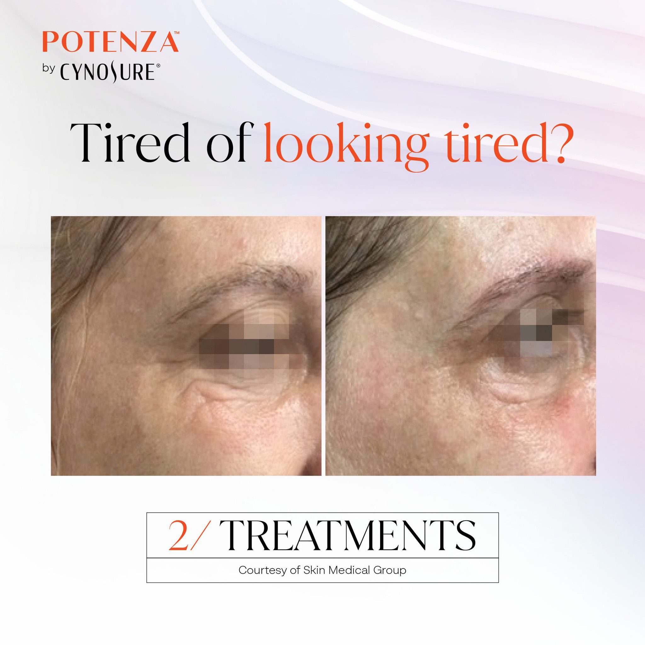 Tired of looking tired? Potenza RF Microneedling Toronto