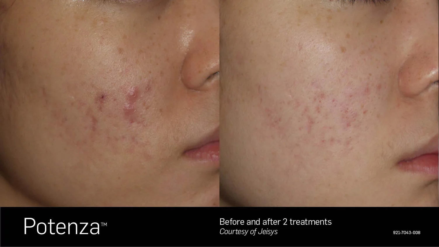 Potenza RF Microneedling for acne scars
