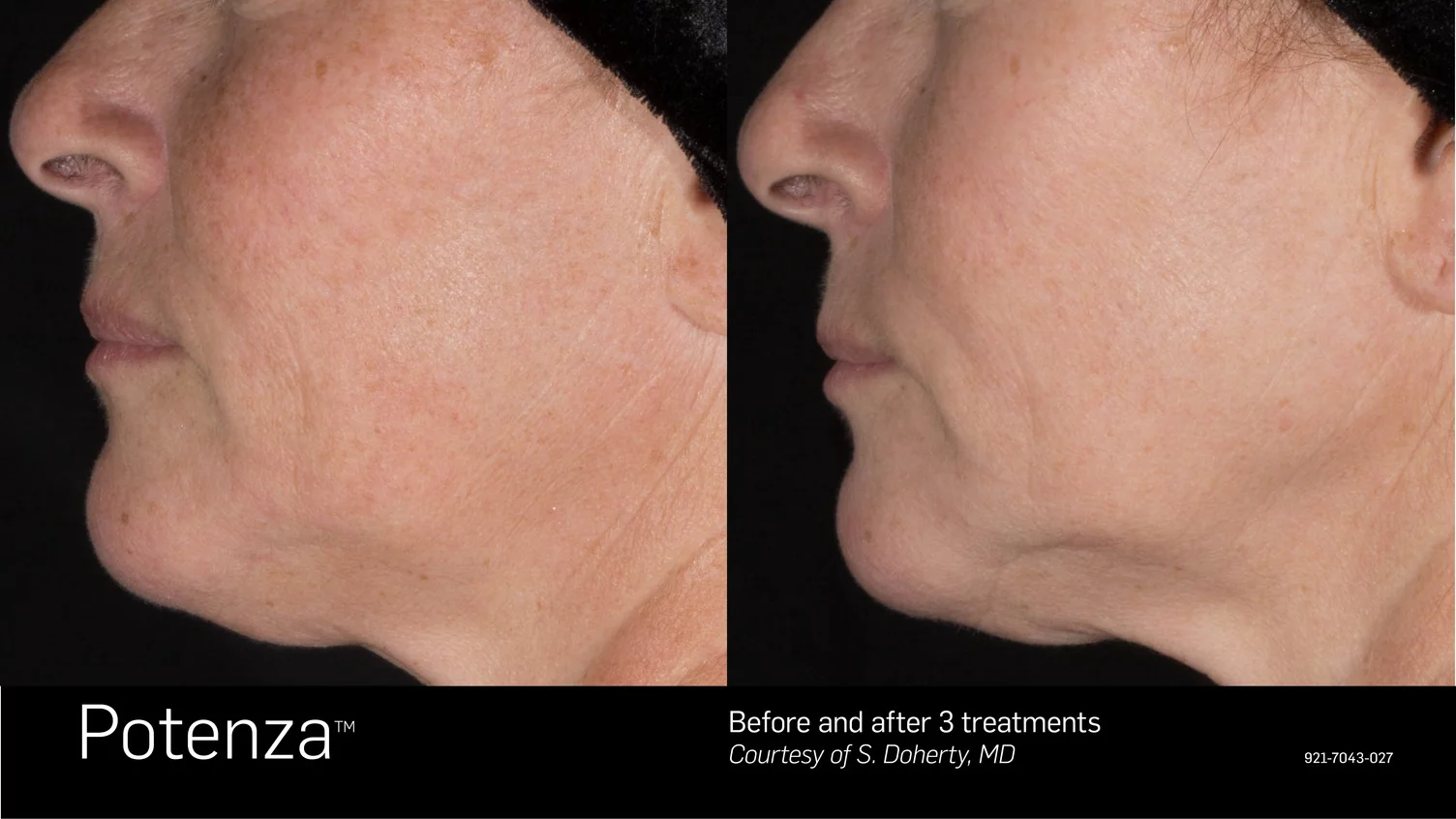 Potenza Radiofrequency Microneedling Before and After