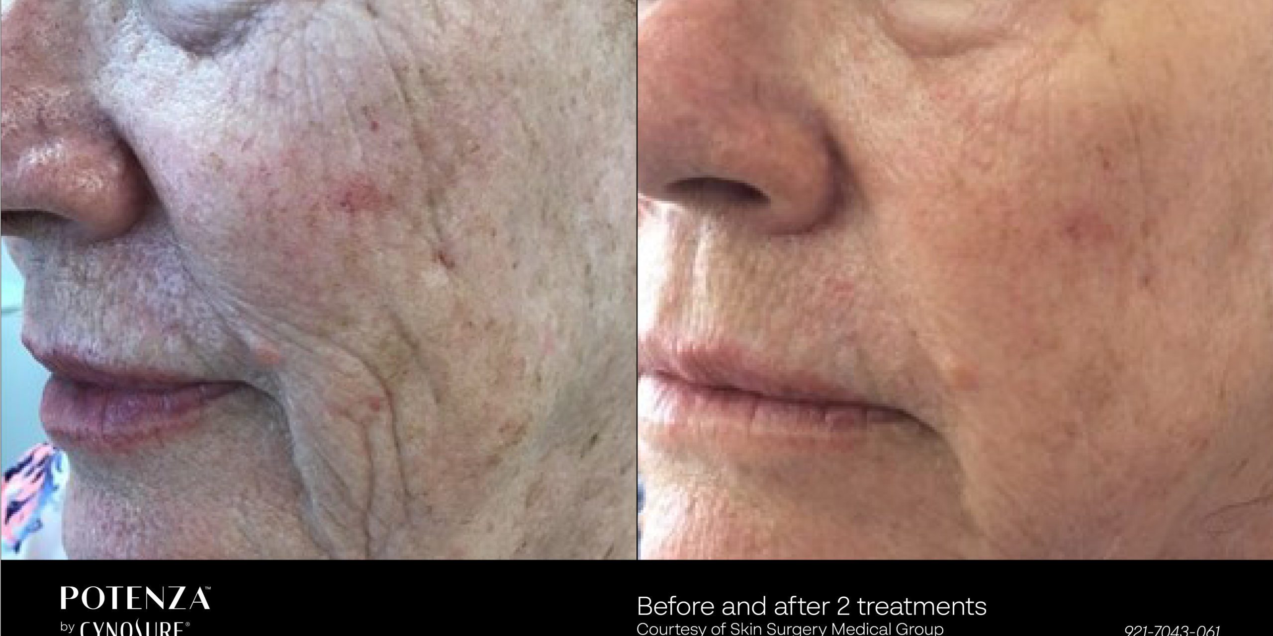 Potenza Radiofrequency Microneedling Before and After