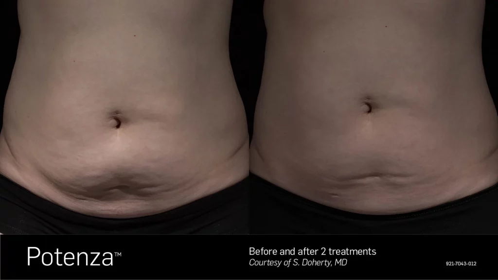 Stretch Marks Removal Toronto - Bellair Laser Clinic