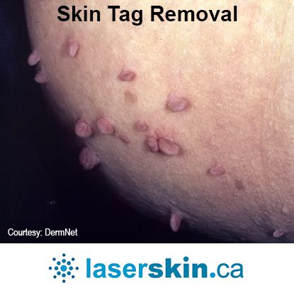 Skin Tag Removal