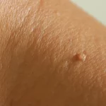 Skin-Tag-removal