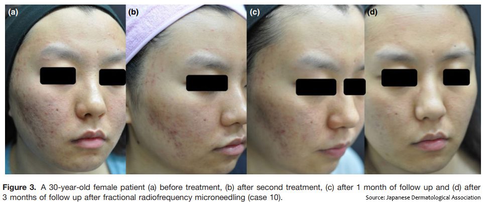 acne treatment Toronto