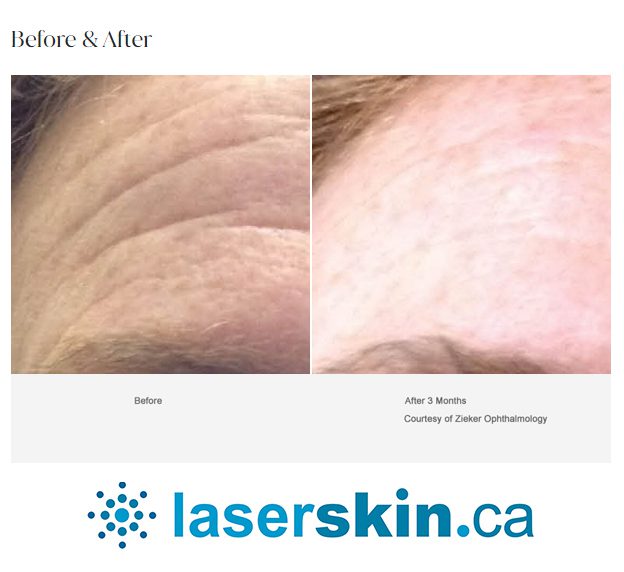 fine lines and wrinkles removal treatment