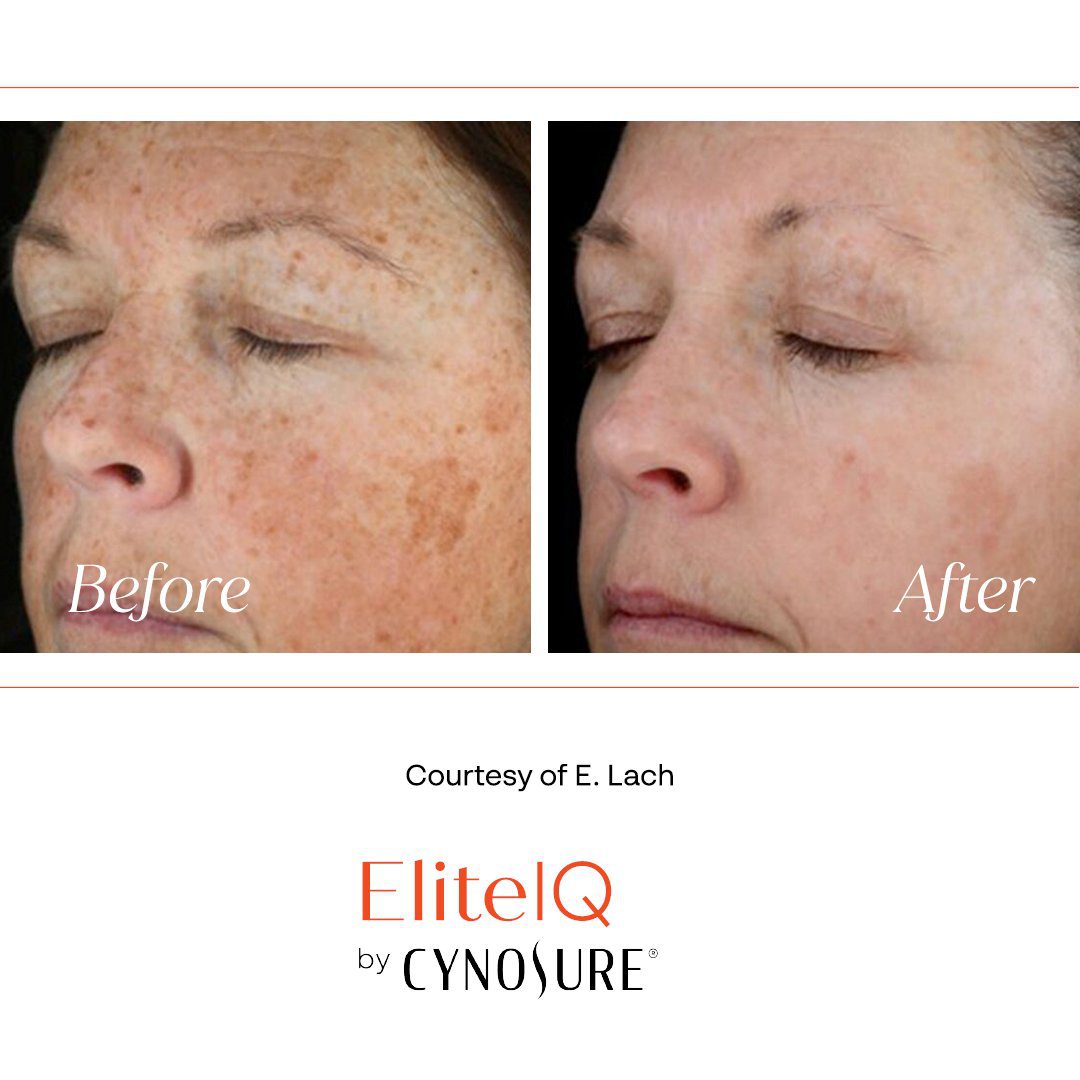 cynosure elite iq laser