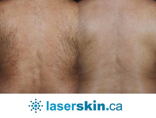 laser hair removal for men