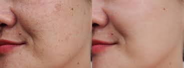 laser sun damage treatment for sun damaged skin Toronto before and after