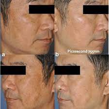 laser sun damage treatment for sun damaged skin Toronto before and after