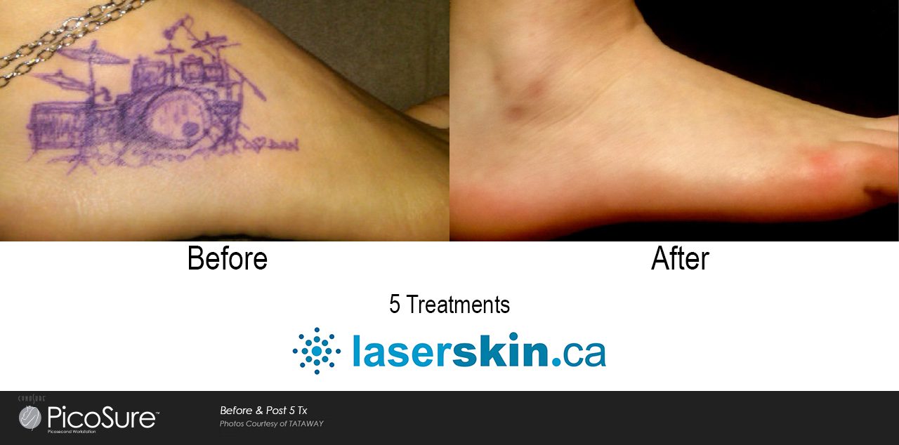 Does Tattoo Removal Leave a Scar Behind?: Bruce Sanderson, MD: Laser &  Medical Spa