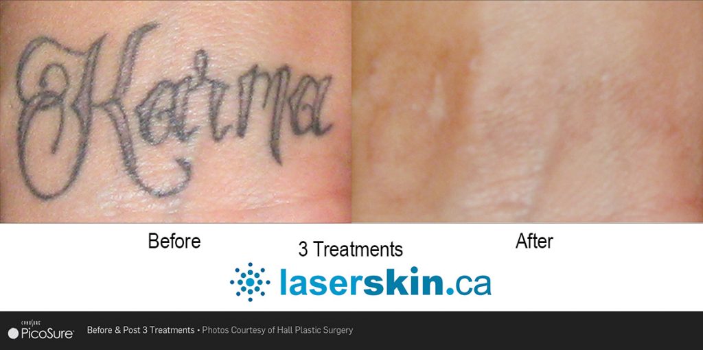 laser-tattoo-removal-before-and-after-4
