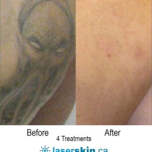laser-tattoo-removal-before-and-after-6