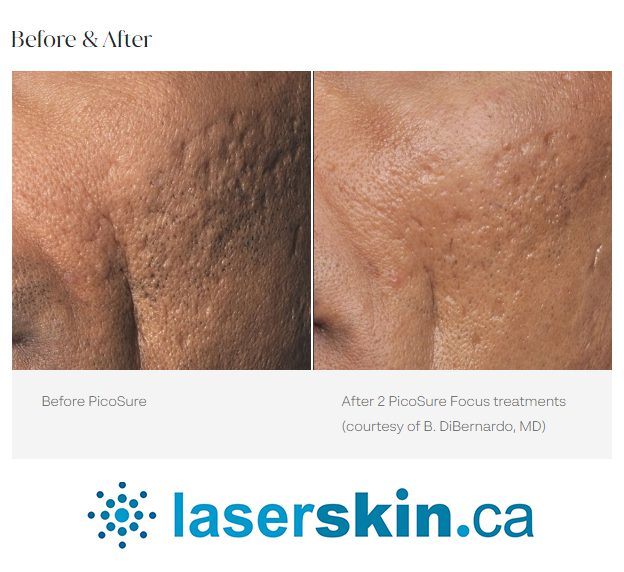 picosure laser for acne scars Toronto