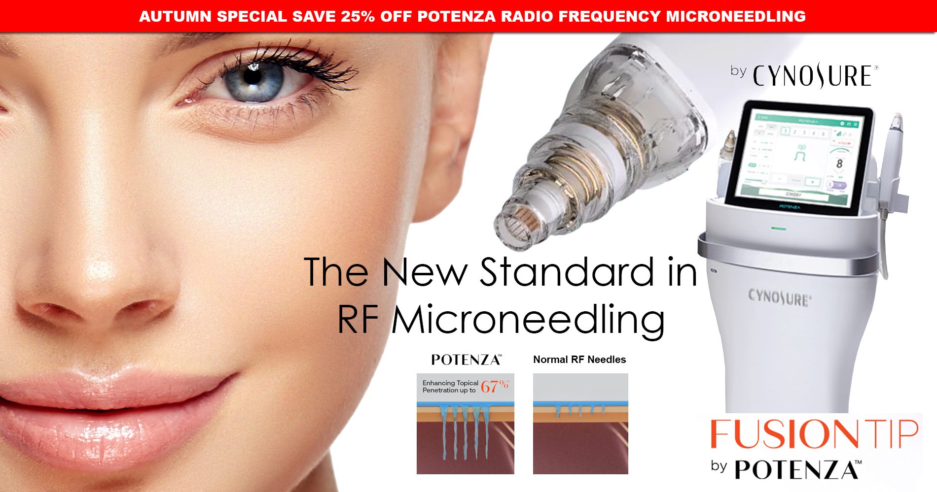 potenza-rf-microneedling