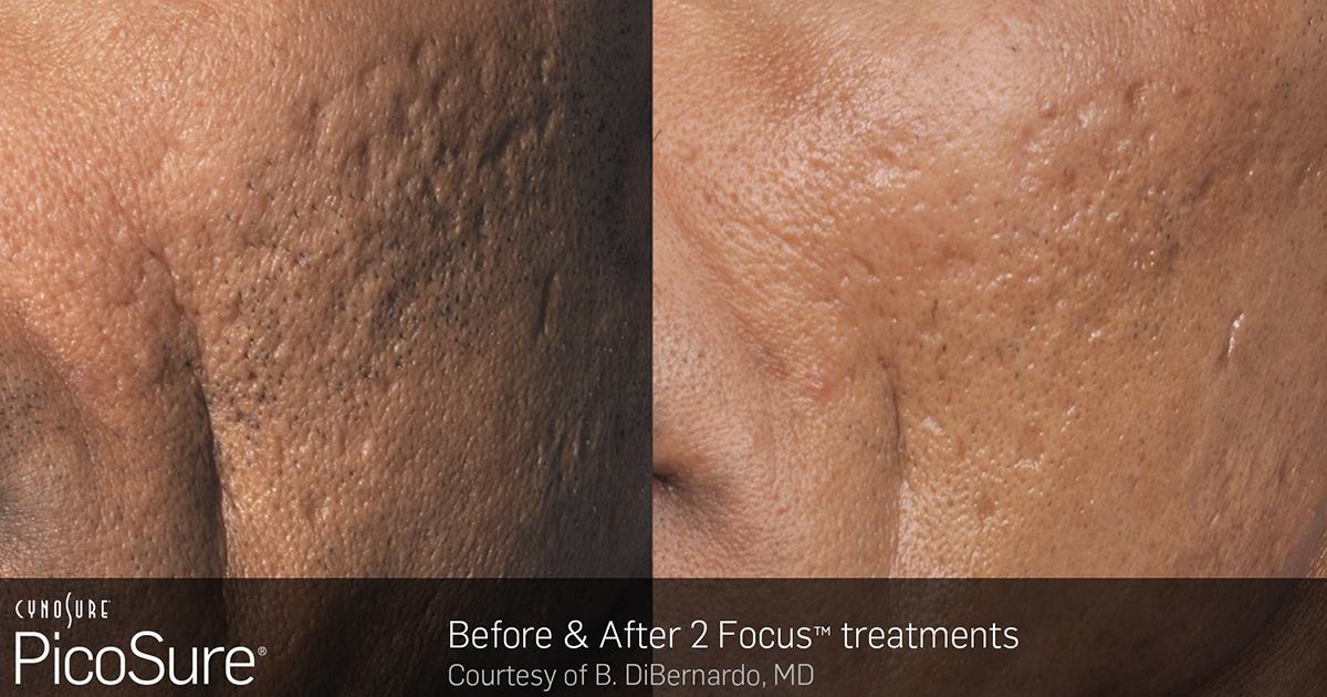 PicoSure acne scars treatment Toronto