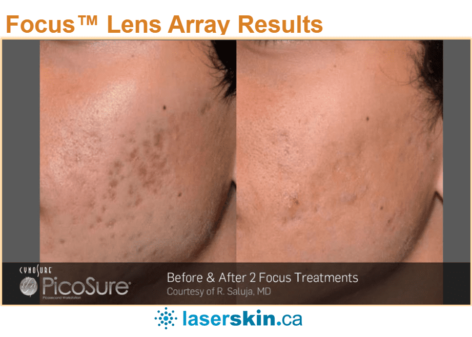 Picosure Focus for acne scars Toronto