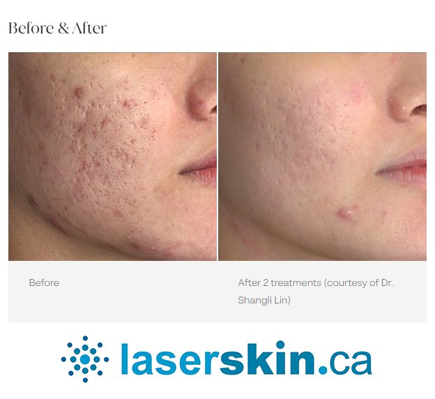 Picosure Laser Treatment for Acne Scars Toronto