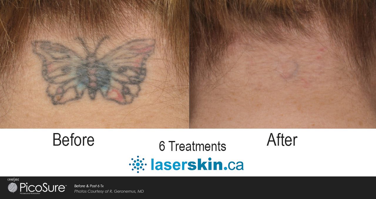 Picosure before and after Toronto