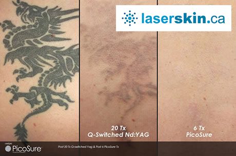 Picosure tattoo removal Toronto