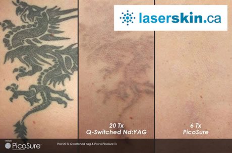 chest tattoos for men - Picosure laser tattoo removal Toronto
