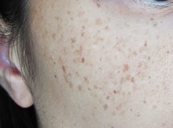 freckles removal Toronto