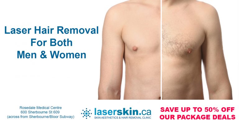 laser hair removal Toronto for men and women