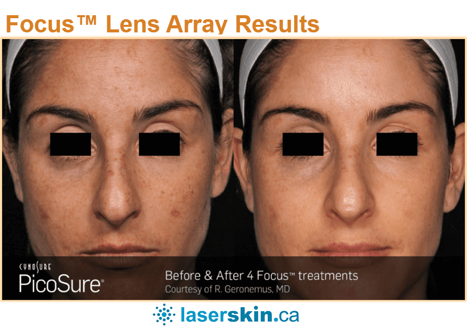 laser resurfacing acne scars Toronto