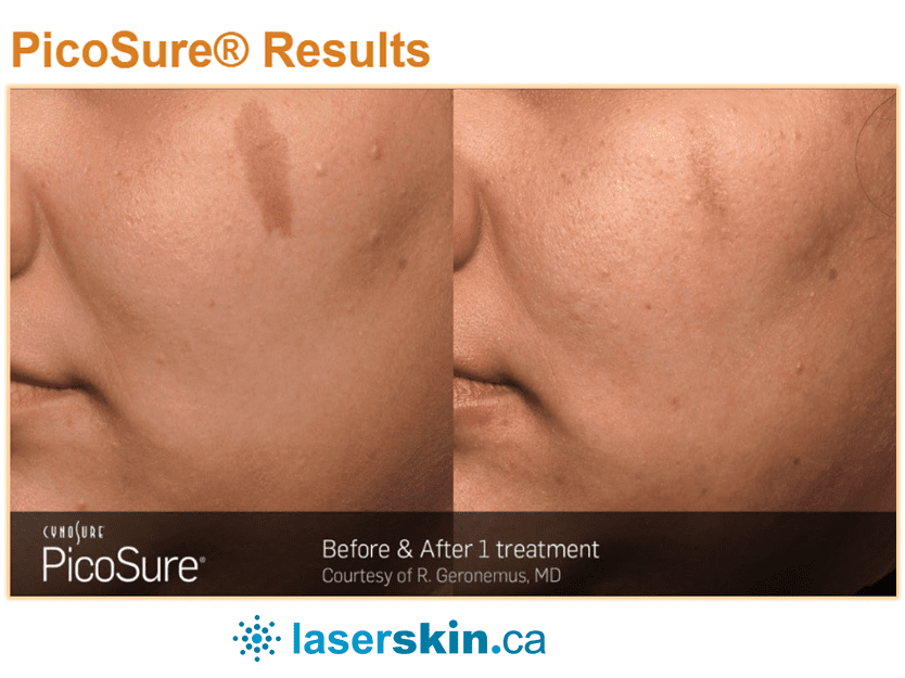 laser resurfacing before and after Toronto