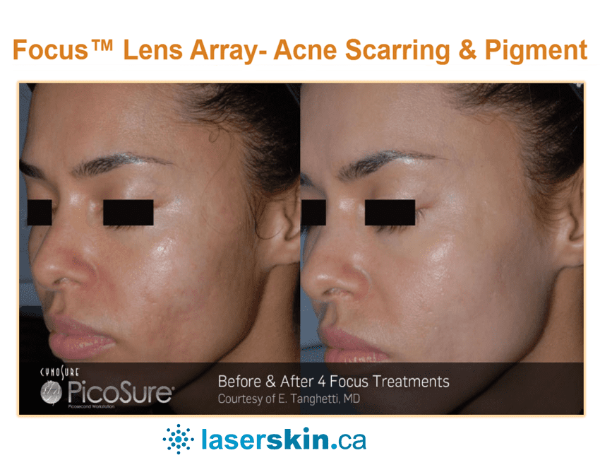 laser resurfacing large pores before and after Toronto