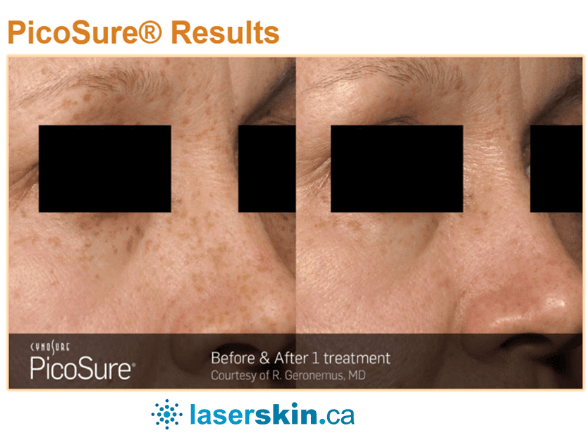 laser skin resurfacing Toronto