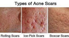 laser treatment for acne scars Toronto