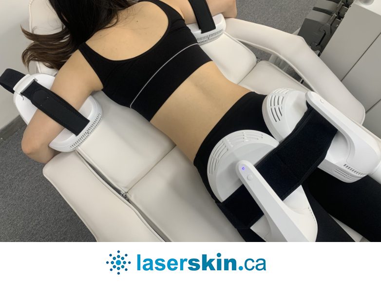 non surgical body contouring before and after Toronto