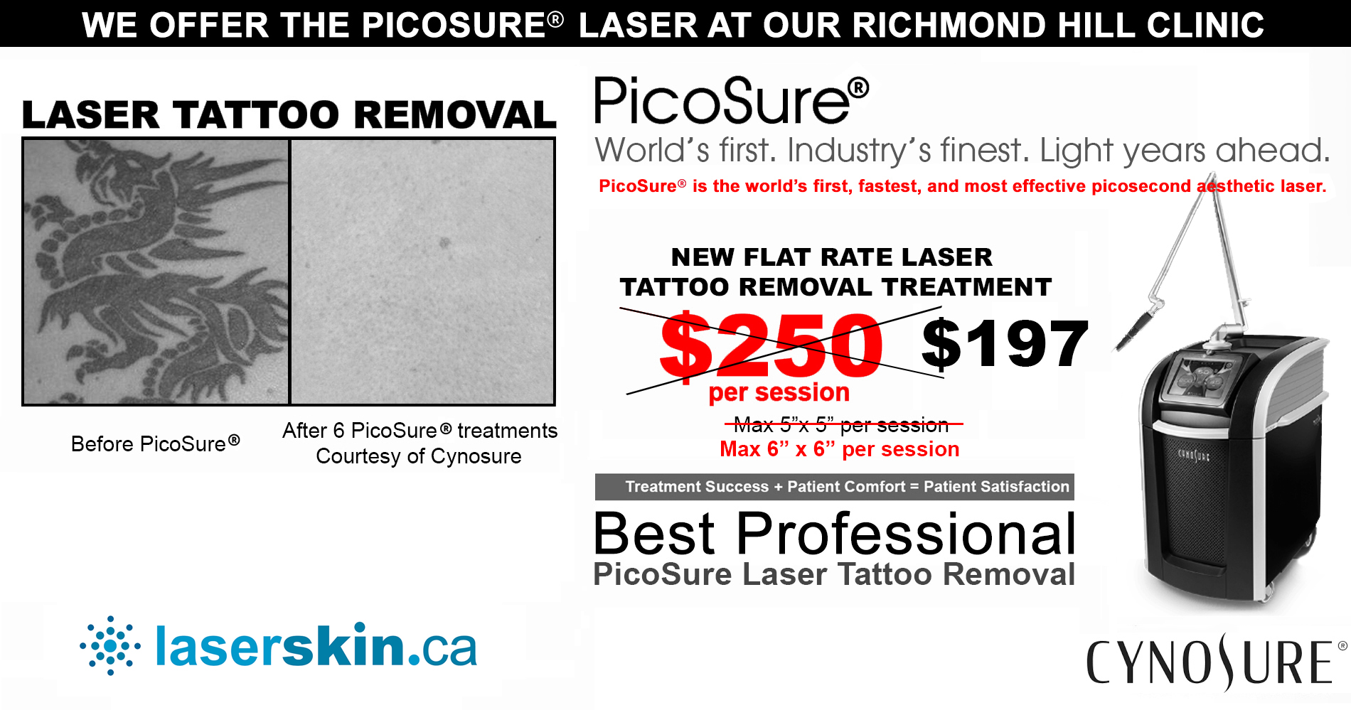 picosure Toronto laser tattoo removal