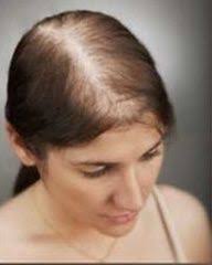 postpartum hair loss