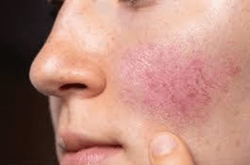 rosacea treatment Toronto