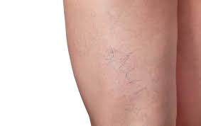 spider veins on legs Toronto