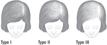 womens hair loss Toronto