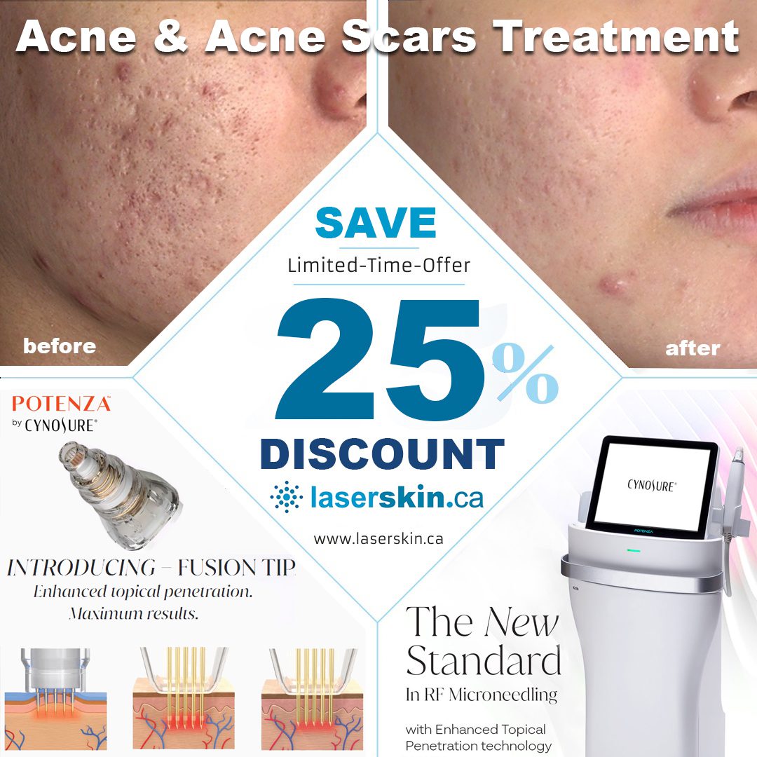 Laser Treatment For Acne Scars Toronto
