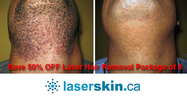 full body laser hair removal Toronto CA