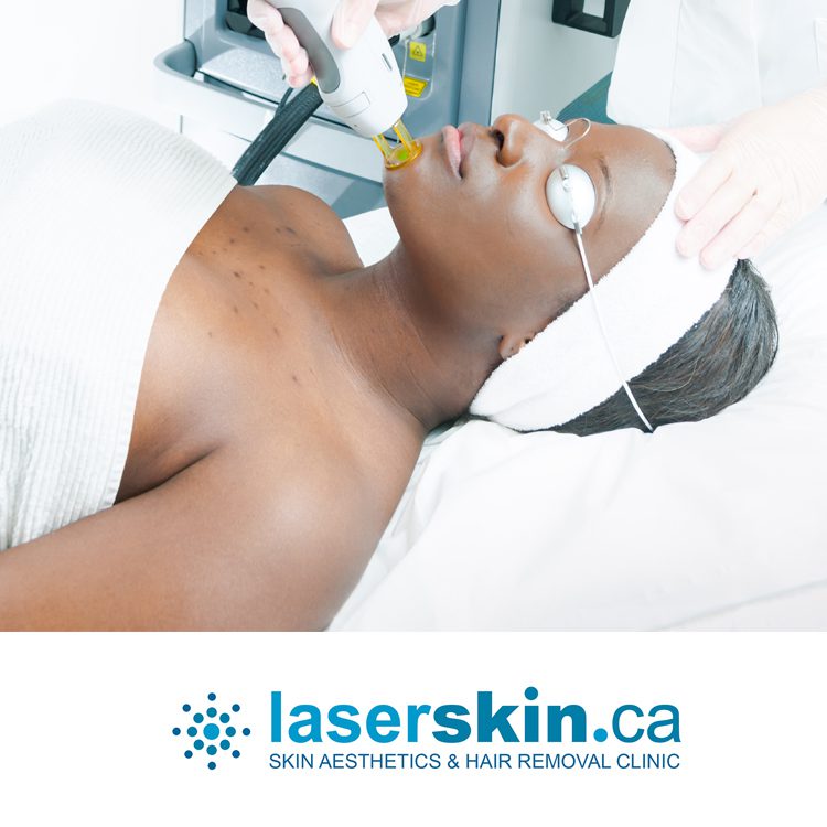 how many sessions for laser hair removal Toronto