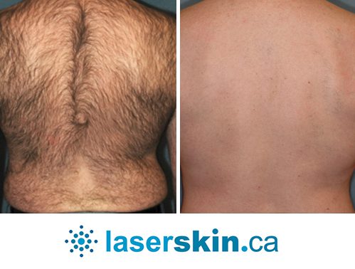 laser hair removal side effects Toronto